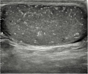 Microlitiasis testicular.