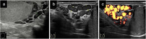 a) Varicocele leve (vaso dilatado medido entre cruces); b) Varicocele moderado/severo (vasos dilatados medidos entre cruces); c) Varicocele de imagen «b» con captación Doppler con maniobra de Valsalva en relación con reflujo.