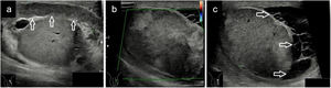 a) Epididimitis con engrosamiento e hipoecogenicidad del epidídimo (señalado con flechas y medido su grosor entre cruces); b) Orquitis avanzada con zonas de marcada hipoecogenicidad del parénquima testicular y área periférica abscesificada con captación Doppler; c) Evolución de «b» una semana después con área abscesificada en polo inferior testicular con hidrocele tabicado secundario (señalado con flechas).