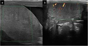 a) testículo muy aumentado de tamaño con ausencia de captación Doppler color en el contexto de una torsión testicular evolucionada (24h); b) Testículo contralateral sano de tamaño normal con captación de Doppler color con los mismos parámetros que en «a».