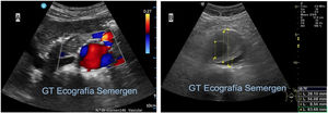 A)Corte transversal en mesogastrio. Ectasia de aorta abdominal con un eje anteroposterior de 27mm. B)Corte transversal en mesogastrio. Aneurisma de aorta abdominal disecado con un eje anteroposterior de 6,3cm, una luz de 2,8cm, trombo mural en cara anterior, posterior y lateral izquierda y luz de la disección de unos 8mm.