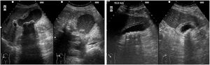 Corte longitudinal y transversal de la vesícula biliar donde se observan criterios de colecistitis: engrosamiento y edema de la pared y litiasis. Además, en la imagen A se observa material purulento en el interior de la vesícula.