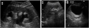 A)Corte longitudinal del riñón donde se observa una moderada hidronefrosis, con dilatación de la pelvis renal y de los cálices. B)Corte longitudinal del riñón derecho: se observa una litiasis en la pelvis renal de unos 20mm. Imagen C)Corte longitudinal a nivel pélvico: se observa una litiasis en el uréter distal izquierdo de unos 9mm.