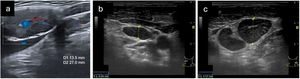 Adenopatías reactivas. A. Adenopatía reactiva cervical en el contexto de mononucleosis infecciosa. En la imagen ecográfica apreciamos un ganglio con eje corto aumentado de tamaño (mayor a 10mm). Mantiene morfología ovalada (con diámetros 27×13,5mm), con adecuada diferenciación corticomedular y vascularización hiliar evidenciada con el uso de Doppler en dicha imagen. B.En la región cervical derecha, según el pictograma de la imagen, se evidencia una adenopatía reactiva, de diámetro anteroposterior menor a 10mm y sin evidenciarse hilio ecogénico central. C. En la región cervical izquierda, según el pictograma de la imagen, se aprecian 2 adenopatías reactivas, de morfología ovalada y diámetro anteroposterior algo aumentado (1,17mm).