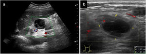 Adenitis supurativa. A. Adenitis abscesificada intraabdominal en el contexto de abandono de tratamiento antituberculoso, en un corte longitudinal al nivel del epigastrio. Se observa una adenopatía claramente atípica redondeada, pérdida de la diferenciación corticomedular, hipoecogénica y heterogénea, en la que no existe captación Doppler. B. En la región cervical derecha, según el pictograma de la imagen, se evidencia adenopatía cervical atípica. Se aprecia un aumento de tamaño delimitado por (+) (diámetros 2,07×1,41mm), pérdida de configuración corticomedular con zona necrótica anecogénica central con zona periférica de ecogenicidad aumentada y captación Doppler en dicha región periférica.