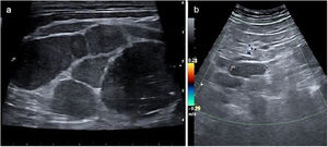 Conglomerado adenopático en cadena cervical izquierda en un paciente finalmente diagnosticado de carcinoma de esófago. A. Múltiples adenopatías redondeadas con pérdida de la diferenciación corticomedular. B. Adenopatías atípicas retroperitoneales, en un corte transversal al nivel de la aorta abdominal, en el mismo paciente. La adenopatía remarcada tiene un diámetro mayor a 35mm y no se aprecia captación Doppler en su interior.