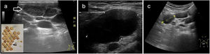 Adenopatías en linfoma. A. En la región cervical izquierda, según el pictograma de la imagen, se evidencia un conglomerado adenopático en un paciente con linfoma. Se aprecian múltiples adenopatías aumentadas de diámetros aumentados y morfología redondeada, con el característico patrón reticular de los linfomas (más patente en adenopatía señalada con fecha blanca). Esta imagen ecográfica correspondería con el patrón en panal de abejas reflejado en la imagen inferior izquierda, de elaboración por la autora de la correspondencia. B. Adenopatía en la región axilar, aumentada de tamaño, anecogénica, con pérdida de la diferenciación corticomedular, posteriormente confirmado el diagnóstico de linfoma folicular. C. En un corte transversal al nivel de la aorta abdominal, según el pictograma de la imagen, se aprecian adenopatías retroperitoneales en el contexto de un linfoma, de morfología redondeada la señalada con «+», sin diferenciación corticomedular.
