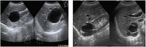 Imagen de la izquierda: Corte longitudinal y transversal en hipocondrio derecho. Quiste simple cortical de paredes finas, sin contenido, de unos 7cm. Imagen de la derecha: Corte longitudinal y transversal en hipocondrio derecho. Quiste cortical de paredes finas, con algún tabique fino en su interior.