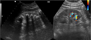 Imagen de la izquierda: Corte longitudinal del riñón derecho con litiasis: imágenes hiperecogénicas en todos los cálices en forma de teja, con sombra acústica posterior. Imagen de la derecha: Corte del riñón izquierdo con 2 imágenes de litiasis con artefacto centello con Doppler color.