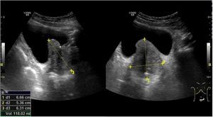 Corte longitudinal y transversal en hipogastrio con medición del eje longitudinal (d3: 63mm), transversal (d2: 53mm) y anteroposterior (d1: 66mm) de la próstata con un volumen de 118cc, es decir crecimiento prostático grado IV, con crecimiento del lóbulo medio.