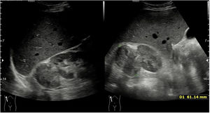 Corte longitudinal/oblicuo del riñón derecho con una lesión en el polo superior sólida, heterogénea, de bordes bien definidos, de unos 6cm de eje mayor, que parece depender de la corteza renal, por tanto, compatible con tumor renal.