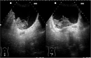 Corte longitudinal y transversal en hipogastrio donde se observa una vejiga bien replecionada con una lesión sólida, heterogénea, dependiente de la pared posterior vesical.