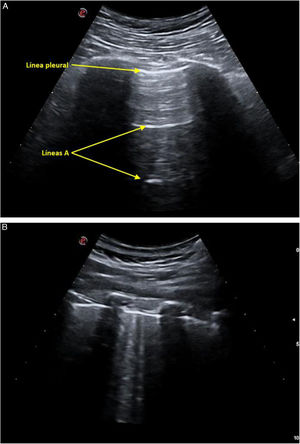 Ecografía pulmonar. A) Estudio normal del compartimento anterior y superior del hemitórax derecho que revela la línea pleural como una línea hiperecoica horizontal entre 2 imágenes que dejan sombra acústica posterior, correspondientes a 2 costillas. Además, paralelas a la línea pleural y equidistantes, se objetivan 2 líneas A. B) Presencia de 2 líneas B en compartimento posterior e inferior del hemitórax derecho. Estas líneas B se visualizan como 2 imágenes lineales, hiperecoicas y verticales, que parten de la línea pleural. Fuente: Imágenes de elaboración propia.