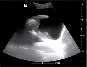 Imagen ecográfica de derrame pleural con atelectasia pulmonar asociada del pulmón derecho. Fuente: Imagen de elaboración propia.