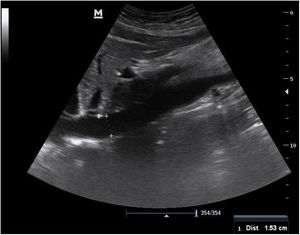 Ecografía de vena cava inferior de tamaño normal (1,53cm) y medida realizada a 2cm de su desembocadura a la aurícula derecha. Fuente: Figura de elaboración propia.