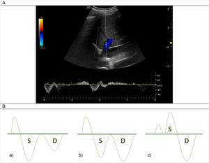 Estudio en un corte longitudinal del hipocondrio derecho logrando visualizar la desembocadura de la vena suprahepática derecha (coloreada de azul en el Doppler color) en la vena cava inferior. A) Ecografía normal del Doppler pulsado de la vena suprahepática. B) Se muestran los cambios en las ondas producidas por el Doppler venoso a nivel de las venas suprahepáticas a medida que avanza la congestión intravascular: a) Normalidad: onda S es mayor que la onda D, ambas negativas; b) Congestión leve: la onda D se hace mayor que la onda S, ambas negativas; c) Congestión severa: la onda S se hace positiva (podría estar alterado basalmente en paciente con insuficiencia tricúspidea severa. Fuente: Imagen y figura de elaboración propia.