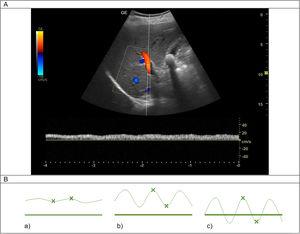 Estudio Doppler pulsado de la vena porta. A) Ecografía normal del Doppler pulsado de la vena porta. B) Se muestran los cambios en las ondas producidas por el Doppler venoso a nivel de la vena porta a medida que avanza la congestión intravascular: a) Normalidad: apenas existe pulsatilidad; b) Congestión leve: las ondas presentan una pulsatilidad >30%; c) Congestión severa: pulsatilidad >50% con ondas que se hacen negativas. Fuente: Imagen y figura de elaboración propia.