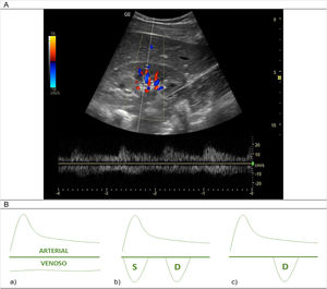 Estudio Doppler pulsado de la vena renal. A) Ecografía normal del Doppler pulsado de la vena renal. B) Se muestran los cambios en las ondas producidas por el Doppler venoso a nivel de las venas intrarrenales a medida que avanza la congestión intravascular. En este caso, las ondas positivas será siempre flujo arterial, por lo que se analizarán únicamente las ondas negativas (flujo venoso): a) Normalidad: patrón monofásico continuo; b) Congestión leve: patrón bifásico discontinuo; c) Congestión severa: patrón monofásico discontinuo. Fuente: Imagen y figura de elaboración propia.