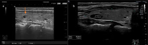 TI-RADS 2 A: Pequeño nódulo de ecogenicidad mixta con componente sólido isoecoico. B: Nódulo de ecogenicidad mixta, algo mayor con componente sólido isoecoico.
