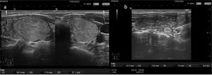 TI-RADS 3 A: Nódulo sólido isoecoico, bien delimitado con halo periférico hipoecoico, de grandes dimensiones, que ocupa la mitad inferior del lóbulo tiroideo. B: Pequeño nódulo sólido hiperecoico, bien delimitado en la cara posterior del tercio medio del lóbulo.