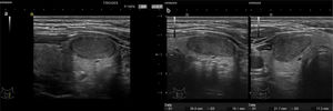 TI-RADS 4 A: Nódulo sólido hipoecoico, muy bien delimitado, en lóbulo izquierdo. B: Nódulo sólido hipoecoico, muy bien delimitado, en vertiente derecha del istmo.