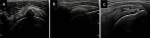 Tipos de calcificaciones en los tendones del MR según su densidad: a) Calcificación tipo I, señalada entre 2 cruces, se observa una sombra acústica posterior que borra completamente la cortical humeral; b) Tipo II (entre cruces), menor ecogenicidad con sombra acústica que borra de manera parcial la cortical; c) Tipo III (entre cruces), grumosa sin sombra acústica posterior.