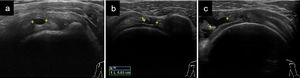 Roturas de los tendones del MR: a) Pequeña rotura del grosor parcial intrasustancia del supraespinoso en un corte longitudinal (entre 2 cruces); b) Rotura del grosor total del supraespinoso inferior a 1cm medido en eje transversal (entre 2 cruces midiendo 0,63cm); c) Rotura del grosor total de mayor tamaño pero menor de 2cm en eje transversal (entre 2 cruces), que afecta a un solo tendón.