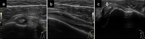 a) Tenosinovitis bicipital observando líquido como un halo hipoecogénico rodeando el tendón del bíceps en un corte transversal en la corredera bicipital; b) Imagen a en eje longitudinal con derrame e imágenes hiperecogénicas en su interior compatibles con hipertrofia sinovial; el tendón del bíceps se muestra algo hipoecogénico y con pérdida de fibrilaridad en relación a tendinopatía; c) En un corte transversal luxación del tendón bicipital (señalado con flecha), que se encuentra fuera y medial a la corredera bicipital.