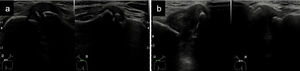Afección en articulación acromioclavicular en imagen dual comparando con hombro contralateral sano: a) A la derecha articulación en hombro izquierdo normal, y a la izquierda hallazgos de artropatía con irregularidad cortical y abombamiento de la cápsula articular en hombro derecho; b) A la derecha articulación en hombro izquierdo normal y a la derecha se observa un aumento del espacio articular y abombamiento de la cápsula en hombro derecho.