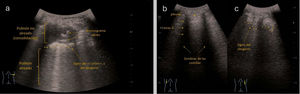 Consolidación no translobar de unos 4cm en lóbulo inferior derecho (LID) en contexto de neumonía de la comunidad. a: en la imagen ecográfica, según el pictograma, se aprecia en un corte transversal (intercostal) en LID, una imagen hipoecogénica de 3-4cm de bordes irregulares, compatible con consolidación pulmonar. En el interior de la lesión, se aprecian líneas hiperecogénicas horizontales de aspecto lenticular, móviles con la respiración; muy indicativas del broncograma aéreo. En área adyacente, perilesional, vemos algunas líneas B o artefacto en cola de cometa. b: comparativa de ambos hemitórax en un corte longitudinal. Según se refleja en el pictograma, en hemitórax izquierdo, se aprecian signos de normalidad: signo del murciélago, patrón de líneas A; además, la imagen en dinámico confirmaba la existencia de deslizamiento pleural y signo de la cortina. c: en hemitórax derecho, según se refleja en el pictograma, la pleura se visualiza como desgarrada, signo conocido como «shred sign». Fuente: Grupo de Trabajo Ecografía de SEMERGEN.