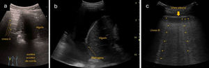 a: signo de la cortina en un corte longitudinal en base pulmonar derecha de un paciente sano: en inspiración, los artefactos de normalidad pulmonar producen un borramiento del órgano abdominal situado caudalmente al pulmón (hígado en este caso). b: derrame pleural en corte longitudinal en base pulmonar derecha: vemos como la ausencia del signo de la cortina nos orienta a la presencia de un derrame pleural en dicha zona. Paciente con diagnóstico final de tuberculosis pulmonar. c: múltiples líneas B (*) en paciente con aumento de su disnea basal en contexto de agudización de su insuficiencia cardiaca en un corte transversal/oblicuado a nivel intercostal: se visualizaban más de 3 líneas B en cada espacio intercostal en más de 2 campos pulmonares de cada hemitórax. Las líneas B (*) parten desde la pleura (flecha gruesa) y llegan hasta el final de la pantalla (flechas finas). Fuente: Grupo de Trabajo Ecografía de SEMERGEN.