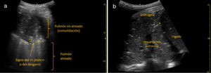 a: consolidación no translobar (signo del desgarro): se objetiva imagen hipoecogénica, de unos 6cm, con imágenes hiperecogénicas en su interior, compatible con consolidación pulmonar con broncograma aéreo en dicho nivel y delimitada del resto del pulmón aireado por una línea fractal (signo del desgarro). b: consolidación translobar (hepatización): en un corte intercostal en base pulmonar derecha se objetiva una imagen de gran tamaño, unos 10cm, con hepatización pulmonar y broncograma aéreo, de un paciente con una neumonía que precisó ingreso en UCI. Fuente: Grupo de Trabajo Ecografía de SEMERGEN.