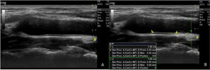 A: corte longitudinal ACC donde se muestra la doble línea ecogénica-hipoecogénica que corresponde al GIM. B: medida del GIM por software automático en un sector de 1cm al menos a 1cm del bulbo carotídeo.