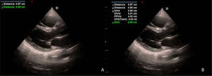 A: eje largo paraesternal. Medición del septo y pared posterior en telediástole. B: eje largo paraesternal. Medición de los espesores de VI y su diámetro telediastólico. A partir de estas mediciones puede obtenerse el MVI.