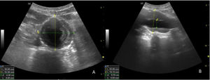 A: corte transversal de AAA a nivel infrarrenal, con trombo intramural. B: corte longitudinal de ese mismo AAA, donde se confirma trombo intramural, con disminución de la luz vascular.