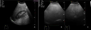 A: corte longitudinal en línea axilar anterior. Aumento de ecogenicidad hepática respecto a cortical renal. Esteatosis leve. B y C: corte oblicuo subcostal en hipocondrio derecho y epigastrio. Atenuación del ultrasonido en regiones posteriores con nula definición del diafragma y los vasos: esteatosis severa.