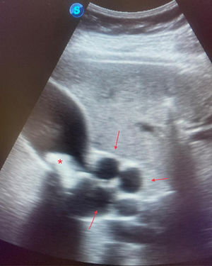 Ecografía abdominal realizada en consulta donde se observa una gran litiasis alojada en el infundíbulo de la vesícula biliar (*), condicionando dilatación y tortuosidad del colédoco (flechas).