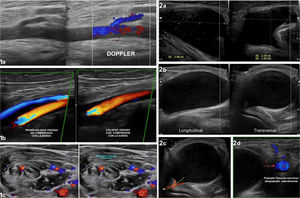 Imágenes 1a-c: Lesiones vasculares (trombosis venosas). 1a) Uso del Doppler para valorar flujo sanguíneo vascular normal. 1b) Compresión con la sonda sobre rombo poplíteo hasta colapsar la estructura venosa. 1c) Visualización trombos intravenosos vs venas permeables con flujo normal (Fuente: Dr. Lafuente). Imágenes 2a-d: quiste de Baker. 2a) Quiste de Baker, medidas, cortes longitudinal y transversal. 2b) Quiste de Baker a tensión, cortes longitudinal y transversal. 2c) Comunicación con cavidad articular receso condíleo pseudoquiste de Baker. 2d) Compromiso vascular en Quistes de Baker a tensión (Fuente: Dr. Lafuente).