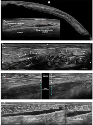 Tríceps sural. a) Vista panorámica de tríceps sural. b) Rotura – desgarro de porción distal de gemelo interno con hematoma suprafascial. c) Rotura gemelar en resolución con organización parcial del hematoma. d) Lesión del fascículo soleo con indemnidad ecográfica del gemelo medial. e) Dehiscencia soleogemelar completa con interposición de hematoma agudo.