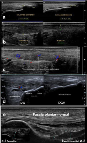 Tendón de Aquiles: a) Entesopatía calcificante: espolón calcáneo bilateral. b) Tendinitis medial del tendón de Aquiles derecho, en comparativa con contralateral normal. c) Neovascularización intratendinosa profunda en proceso tendinosis prolongada. d) Combinación de patologías: rotura fibrilar aquílea con vascularización (+) y bursitis preaquílea (Fuente: Dr. Lafuente). Fascia plantar: e) Fascia plantar sin alteraciones ecográficas en entesis ni en resto de su recorrido plantar (Fuente: Dr. Lafuente).