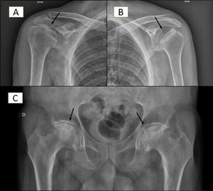 Necrosis aséptica (flecha) en hombro derecho (A), hombro izquierdo (B) y ambas caderas (C).