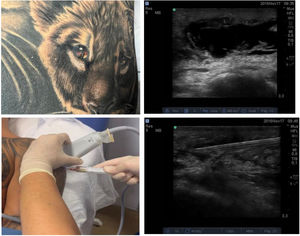 En la imagen superior izquierda se puede observar el tatuaje reciente en el flanco izquierdo del abdomen e hiperemia en el ojo derecho del león tatuado. En la imagen ecográfica superior se visualiza el absceso como una colección heterogénea de aspecto hipoecogénico. En la imagen inferior izquierda se muestra el drenaje ecoguiado en plano, en el hombro izquierdo, accediendo con la aguja desde el lateral de la sonda y describiendo una trayectoria lo más paralela a la sonda, bajo las adecuadas condiciones de asepsia. En la imagen ecográfica inferior destaca la visualización completa de la aguja utilizada para el drenaje como una imagen hiperecogénica y la evacuación completa del material purulento.