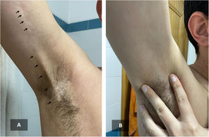 Clinical evolution: initial presentation (A) and two months later (B).