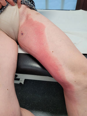 Eritema migratorio. Eritema localizado en la región inguinal con expansión de unos 30cm con aclaramiento central, en esta ocasión con centro necrótico.