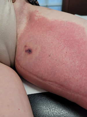 Ampliación del eritema migratorio. Se observa con claridad el centro necrótico, poco habitual.