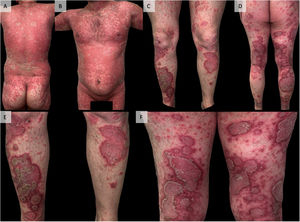 Clinical presentation of cutaneous lesions. Erythematous-scaly plaques of generalized involvement (panels A–D). Panels (E) and (F) provide detailed views of the rupioid and annular appearance of some lesions, respectively.