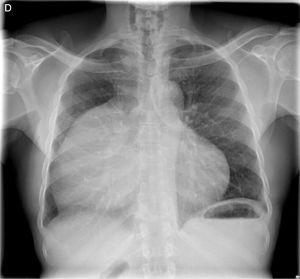 Radiografía de tórax con masa de gran tamaño paracardíaca derecha que ocupa gran parte del hemitórax derecho tributaria de estudio mediante TAC urgente. No se observa derrame pleural.