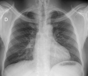 Radiografía de tórax con informe de IA que describe: desplazamiento mediastínico hacia la derecha y aparente colapso pulmonar derecho, posiblemente secundaria a obstrucción bronquial o proceso pleural. Se recomienda realizar una tomografía computarizada de tórax y consultar con un neumólogo. Nota: la visualización de la tráquea desplazada sugiere un colapso pulmonar masivo o una masa mediastínica.