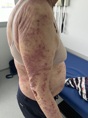 Lesiones eccematosas en el brazo.