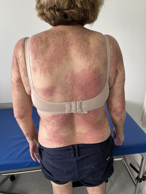 Lesiones eritematosas y costras en el dorso y en los miembros superiores.